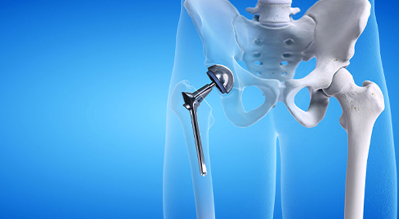 hipreplacement
