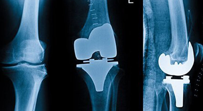 kneereplacement